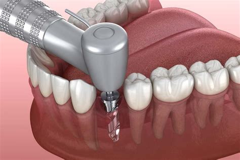 Colocación de implantes dentales paso a paso Mtnez Avilés