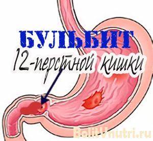 Бульбит 12 перстной кишки диета Бульбит двенадцатиперстной кишки: симптомы, лечение, диета Бульбит двенадцатиперстной кишки: симптомы, лечение, диета Бульбит 12 перстной кишки диета