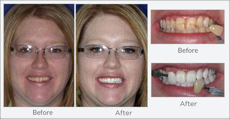 Day To Day Whitening Results Dental Excellence