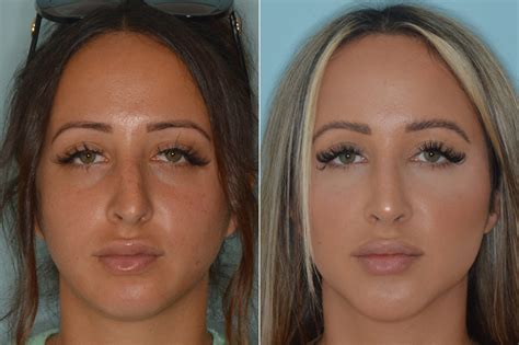 Fixing A Crooked Nose With Rhinoplasty Miami Fl