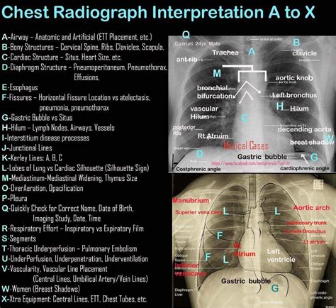 How To Read A Chest Xray Mnemonic Radiology Student Radiographer Medical Education