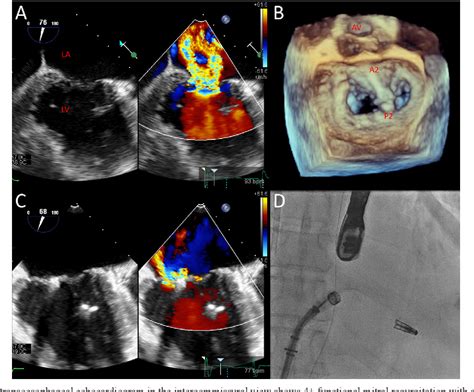 Figure 1 From First Percutaneous Tricuspid Valve Repair With Mitraclip