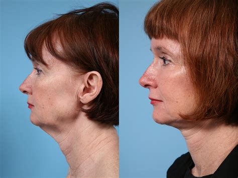 Neck Lift Before And After Photos Patient 145 Chicago Il Tlkm