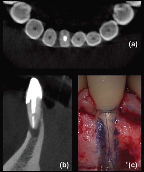 In Vivo Detection Of Vertical Root Fractures In Endodontically Treated