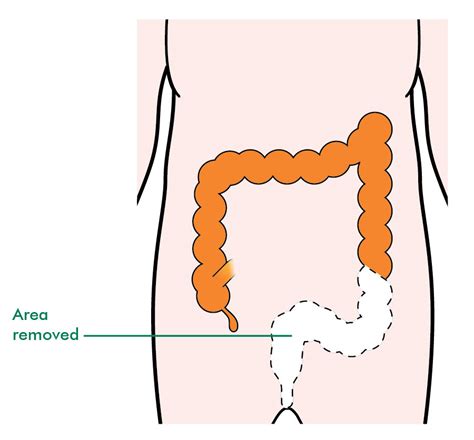Types Of Surgery For Rectal Cancer Information And Support