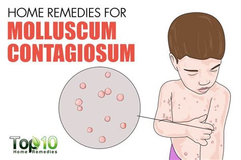Home Remedies For Molluscum Contagiosum Top 10 Home Remedies