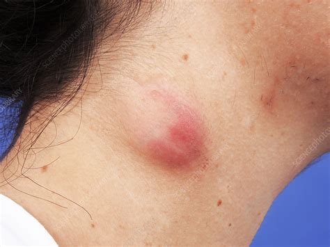 Sebaceous Cyst Stock Image C0254612 Science Photo Library