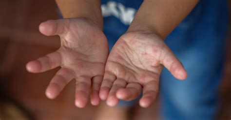Hand Fuß Mund Krankheit Symptome Ansteckung And Tipps