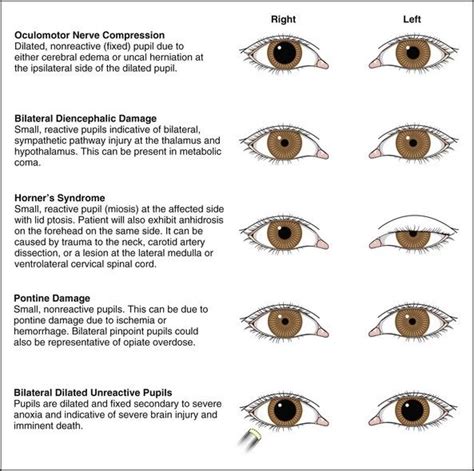 Pupil Anomalies Optometry Medical Knowledge Eye Facts