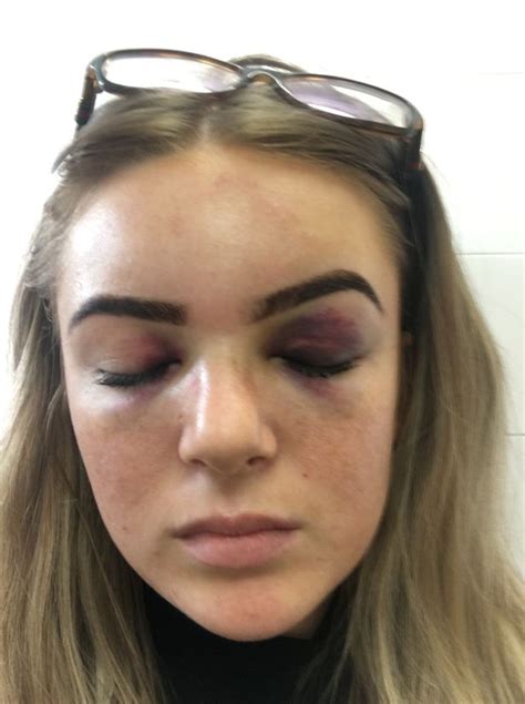 Teen Stripped Naked And Beaten By Boyfriend Reveals How She Found