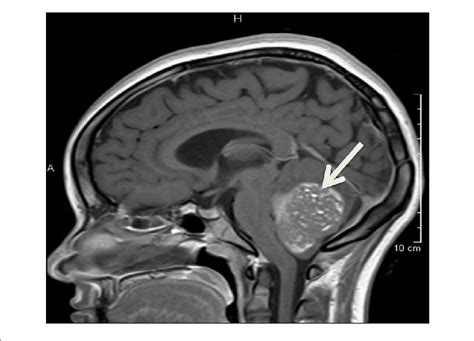 Large Fourth Ventricle Mass Consistent With Medulloblastoma