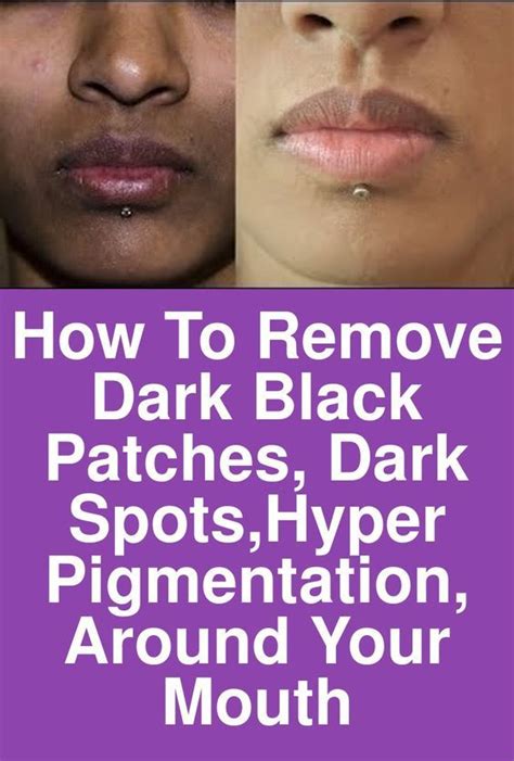 How To Remove Dark Black Patches Dark Spotshyper Pigmentation Around