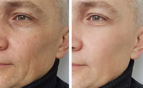 Cosmetic Fillers Advanced Dermatology Of The Midlands Omaha