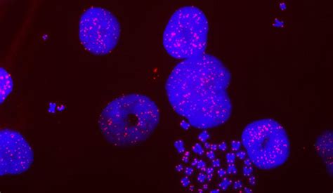 Yale Researchers Discover New Cancer Cell Vulnerability