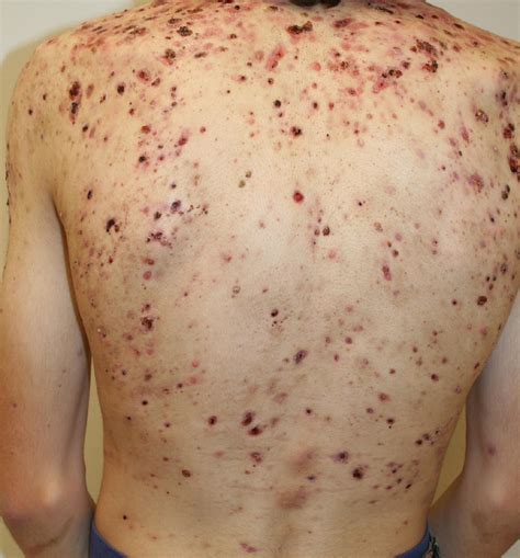 Epidermoid Sebaceous Cysts Brazil Pdf Ppt Case