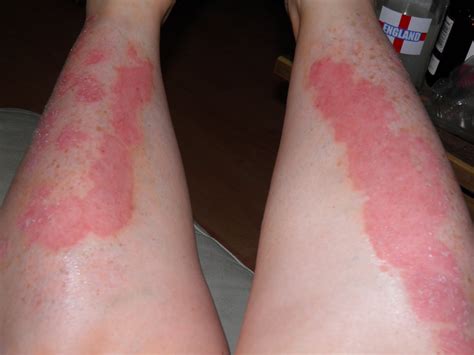 Psoriasis Patches On Legs Dorothee Padraig South West Skin Health Care