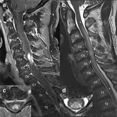 Magnetic Resonance Imaging Mri Of The Cervical Spine Showing Sagittal