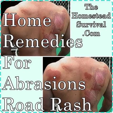 Home Remedies For Abrasions Road Rash The Homestead Survival