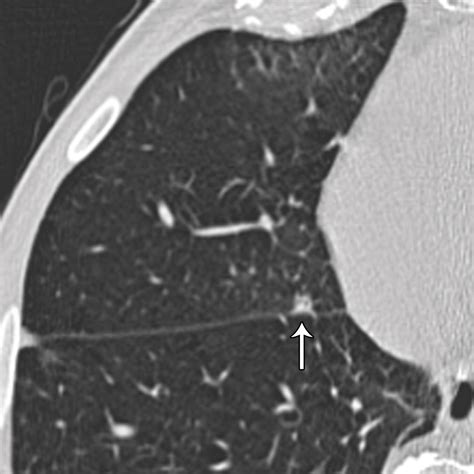 Updated Fleischner Society Guidelines For Managing Incidental Pulmonary