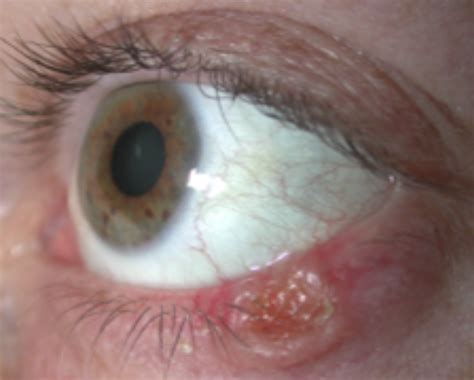 Eyelid Tumours — Dr Ye Chen · Oculoplastic Surgeon And Ophthalmologist