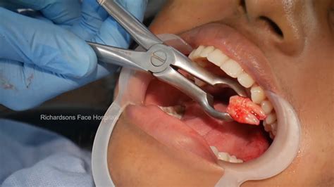 Surgical Wisdom Tooth Extraction By Specialist Surgeon Dr Sunil