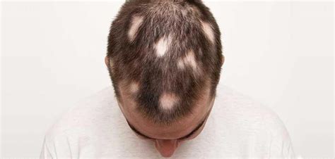 6 Major Types Of Alopecia With Causes Treatments Rephair