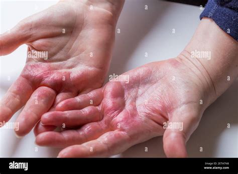 Dermatitis Atópica Roja Picazón En Las Manos Con Ampollas Y Piel
