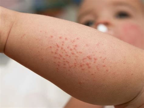 Dermatite At Pica O Que Sintomas Causas E Tratamento Df Expresso Hot