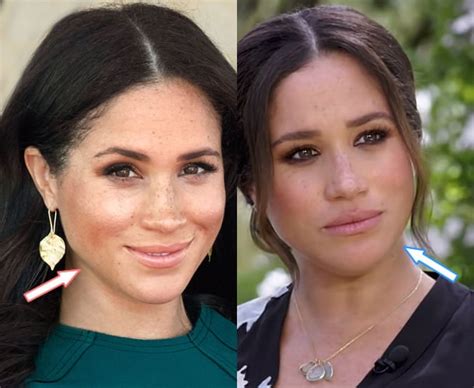 Has Meghan Markle Had Plastic Surgery Before And After 2022