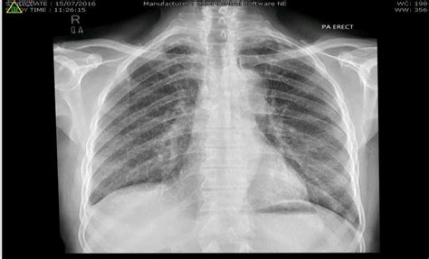 Chest X Ray Showing Calcified Hilar Lymph Node With Blunted Right