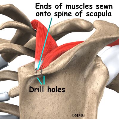 Snapping Scapula Syndrome Osteopathy And Physiotherapy In Northampton