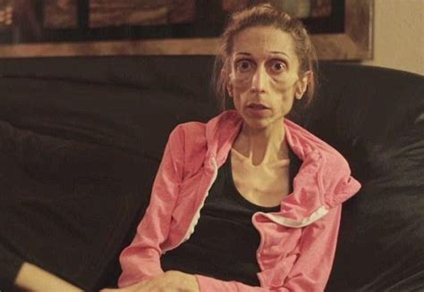aisha 40 pound dying anorexic who made plea for medical help makes recovery photos