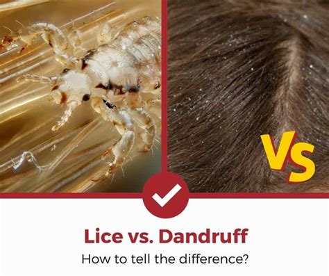 How To Know If You Have Lice Or Dry Scalp