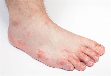 Fungal Foot Infections