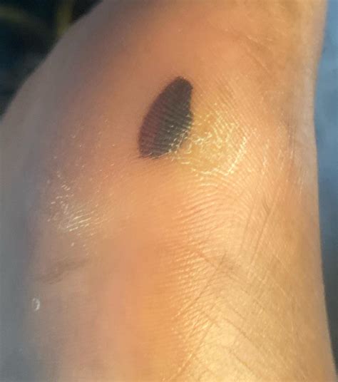 Is This A Blood Blister Or Something Else Rmelanoma