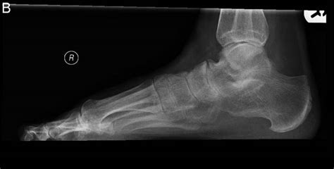 Ankylosis The Foot And Ankle Online Journal