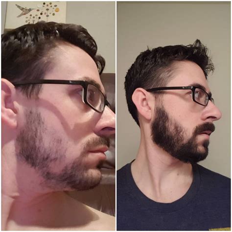 Patchy Beard Success Stories Before And After Photos Page 23 Beard