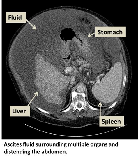 Ascites Interventional Radiology Ucla Health