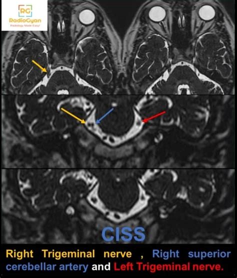 Trigeminal Neuralgia Radiology Case Radiogyan