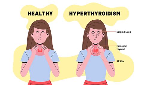 Hyperthyroidism Overactive Thyroid Gland Dr Smita Ramachandran