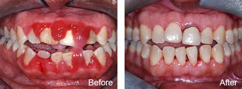 Gum Disease Treatment In Dallas Dallas Periodontal Associates