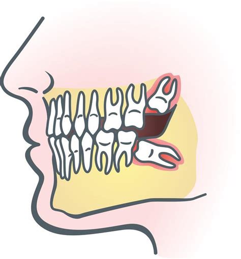 Early Warning Signs Of An Impacted Wisdom Tooth Tompkins Dental