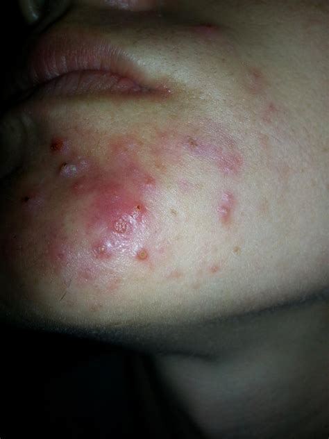 Acne Pics Skin Worse Than Ever 3 Weeks On The Regimen The