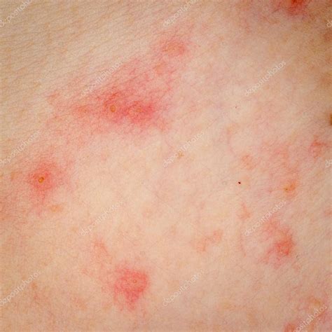 Allergic Rash Dermatitis Eczema Skin — Stock Photo © Panxunbin 18288827