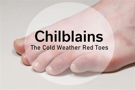 Chilblains The Cold Weather Red Toes Cold Toes Cold Cold Weather