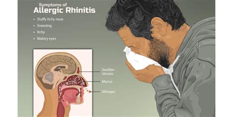 Allergic Rhinitis Hay Fever Signs And Symptoms Uk
