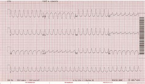 Float Nurse Megacode Unstable Ventricular Tachycardia Part 1