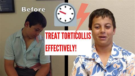 Effective Torticollis Treatment Youtube