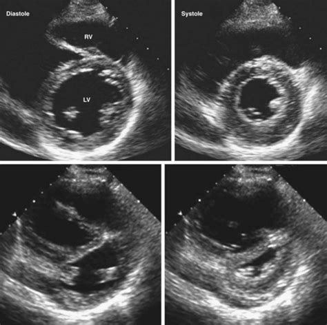 Echocardiography In The Patient With Right Heart Failure Clinical Gate