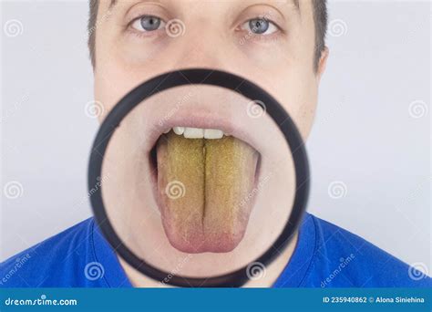 The Man Has A Yellow Tongue Painful Yellow Coating On The Mucous